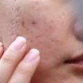 Why Acne Requires a Routine, Not a Single Solution